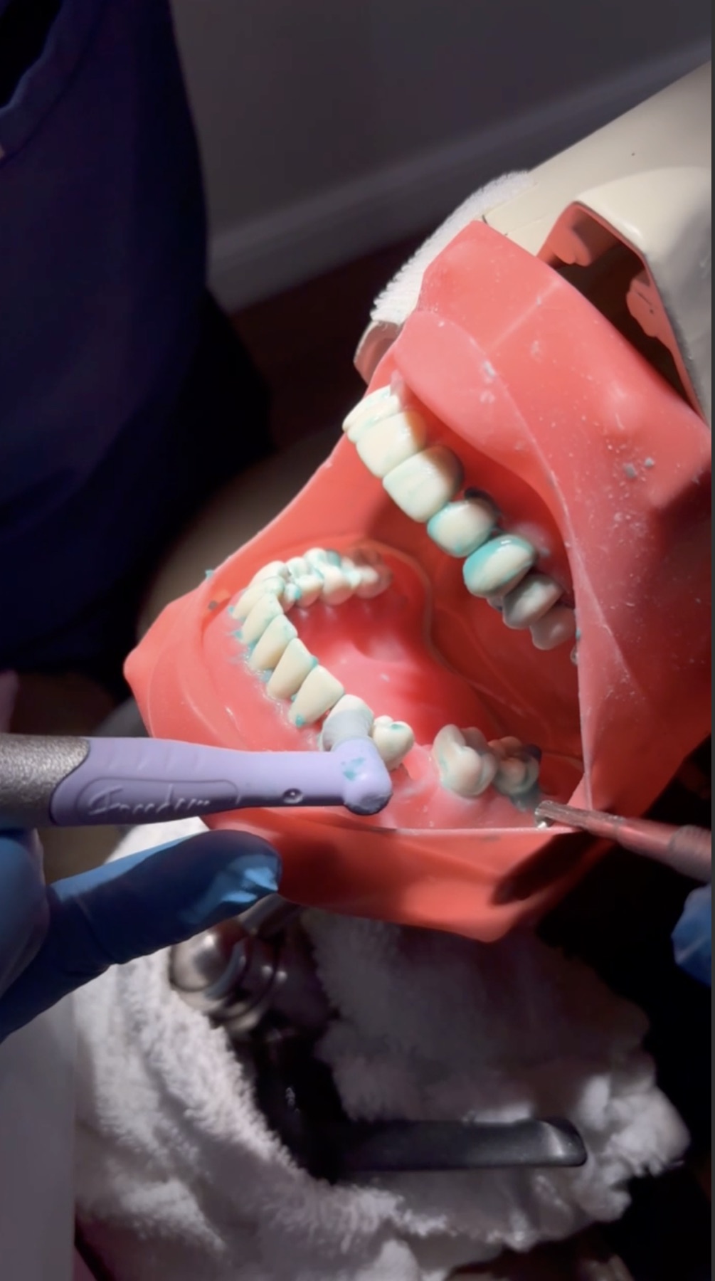 Close-up of coronal polish practice on a dental typodont.